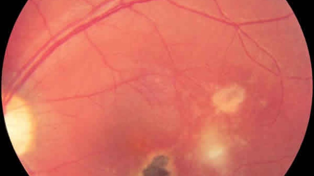 Retinitis y cicatriz de Toxoplasma